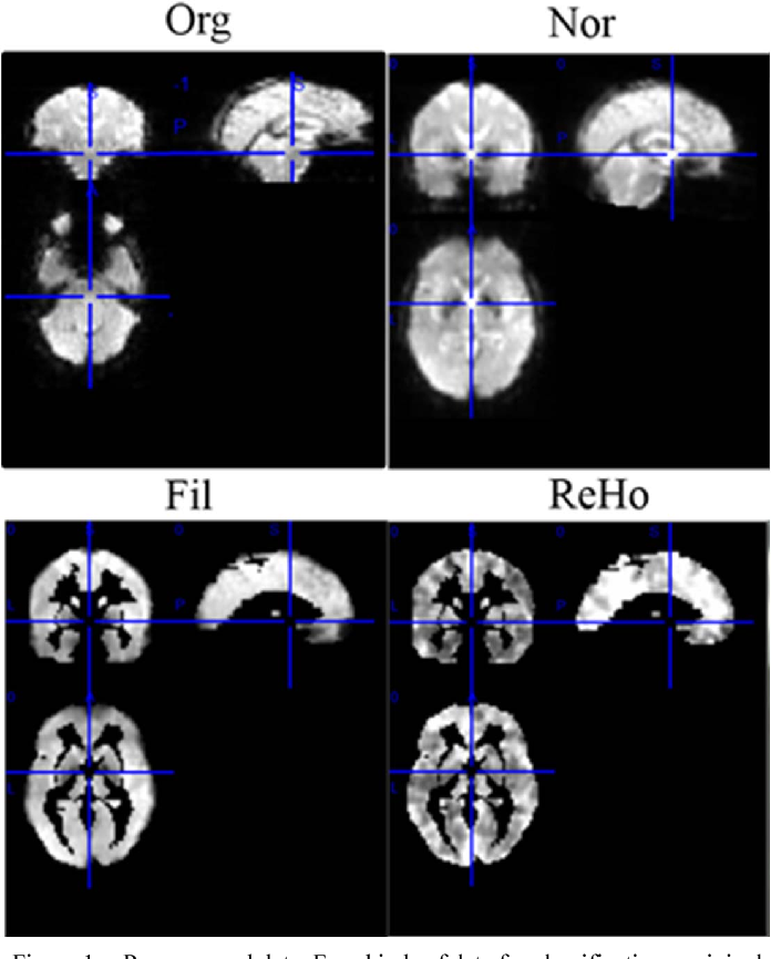 Preclinical Stages of Alzheimer's Disease Classification by a Rs-fMRI Study
